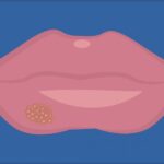 19 055416 stds that show on your face