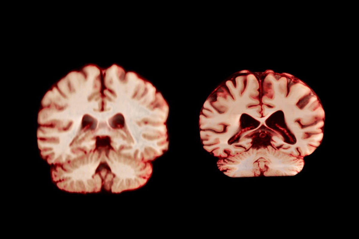 healthy and alzheimers affected brains comparison