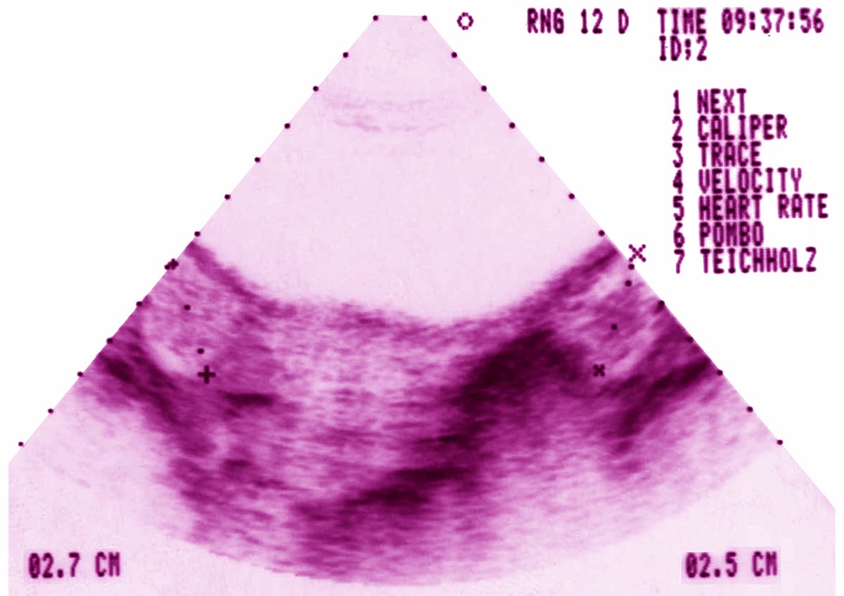 PCOS rename