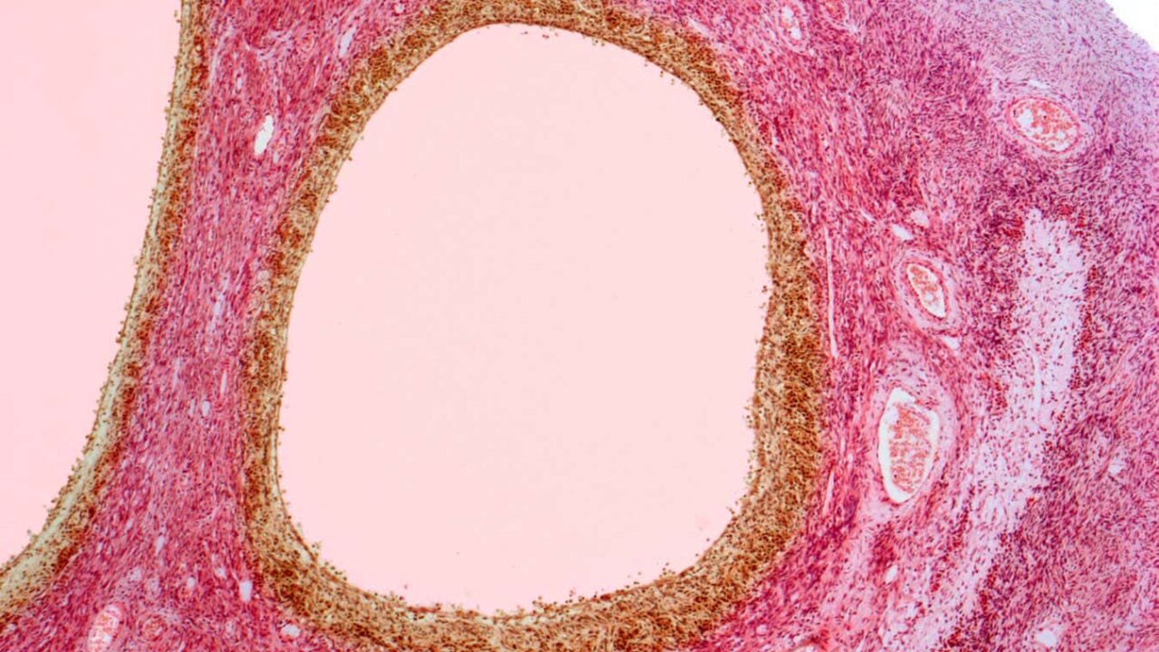 PCOS has been officially renamed PMOS, and it’s a momentous move